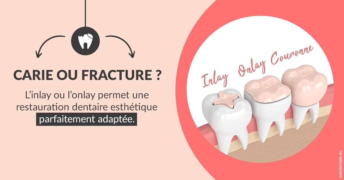 https://selarl-stephane-palmer.chirurgiens-dentistes.fr/T2 2023 - Carie ou fracture 2