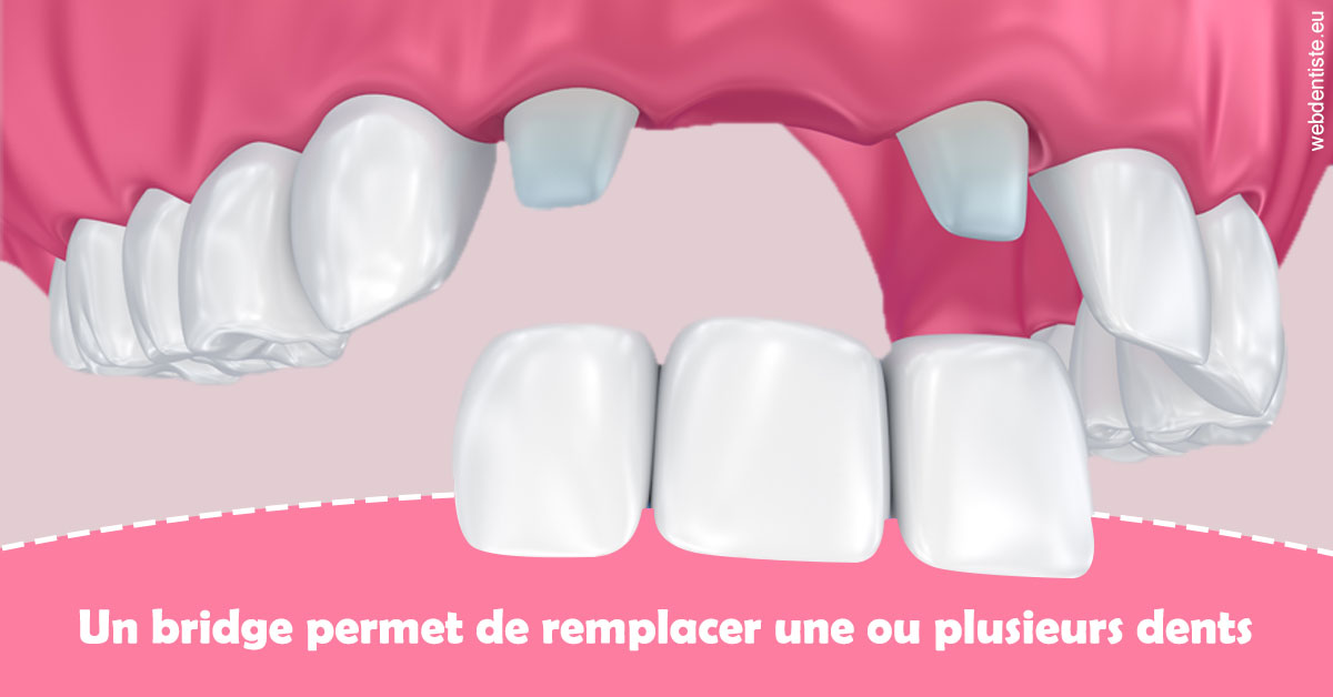 https://selarl-stephane-palmer.chirurgiens-dentistes.fr/Bridge remplacer dents 2