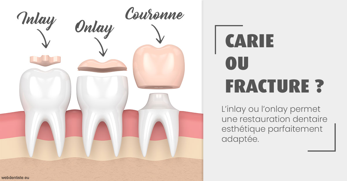 https://selarl-stephane-palmer.chirurgiens-dentistes.fr/T2 2023 - Carie ou fracture 1
