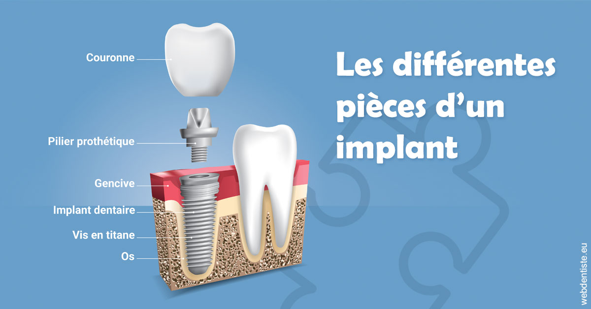 https://selarl-stephane-palmer.chirurgiens-dentistes.fr/Les différentes pièces d’un implant 1